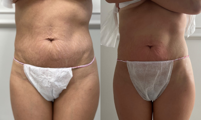 Эндосфера-терапия 2